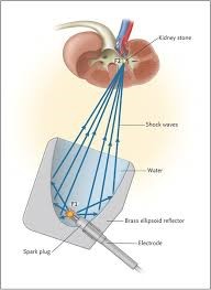 Dr_Ziauddin_Hospital_Lithotripsy