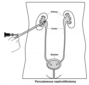 Dr_Ziauddin_Hospital_Lithotripsy_pcnl