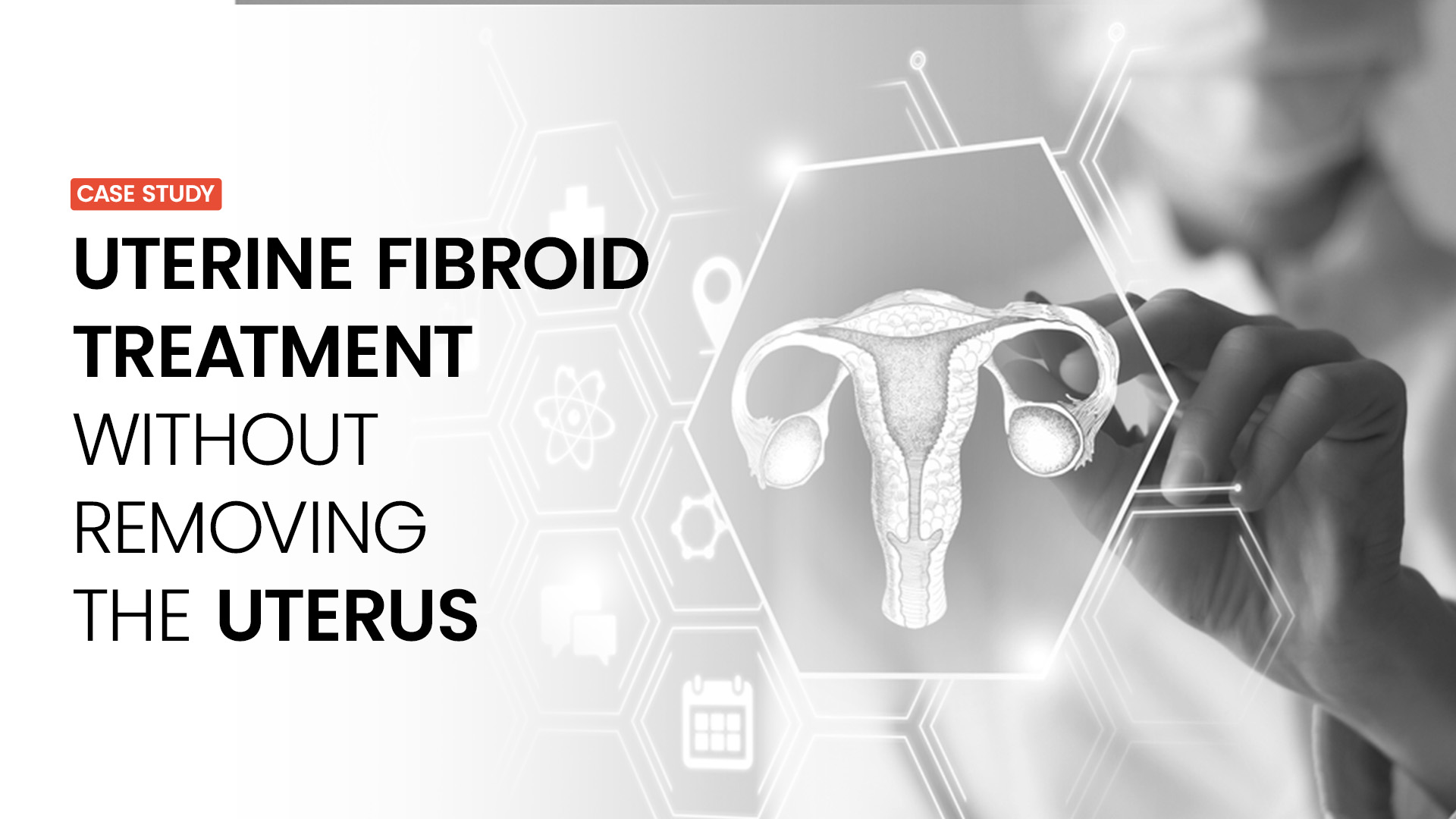 Uterine Fibroid Treatment Without Hysterectomy
